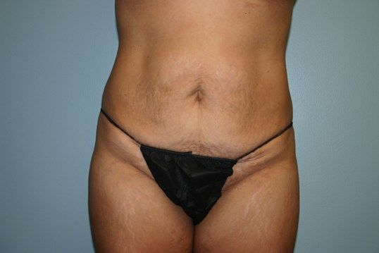 Body Contouring Before & After