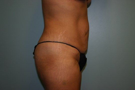 Body Contouring Before & After