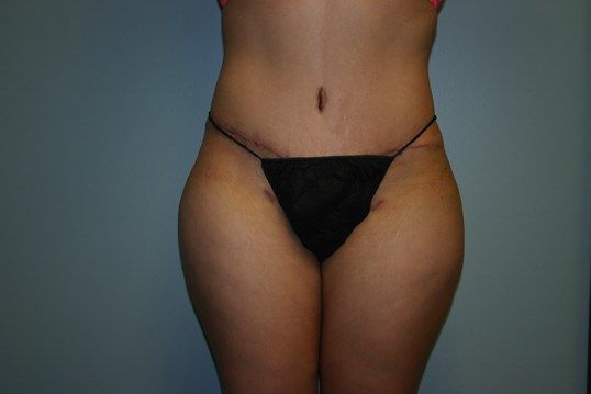 Body Contouring Before & After
