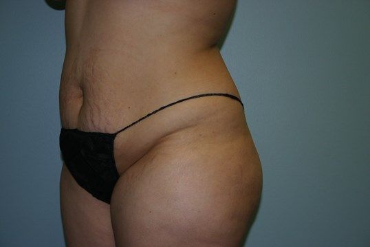 Body Contouring Before & After