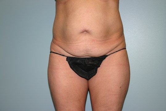 Body Contouring Before & After