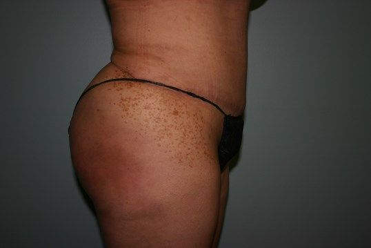 Body Contouring Before & After