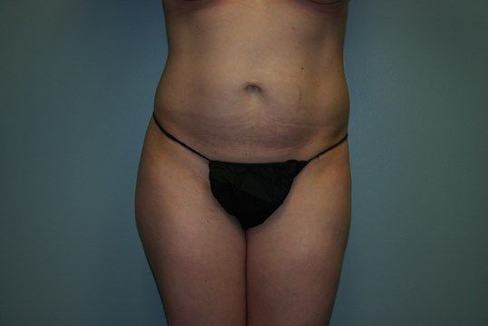 Body Contouring Before & After