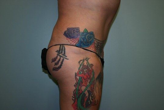 Body Contouring Before & After