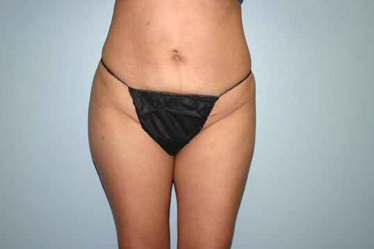 Body Contouring Before & After