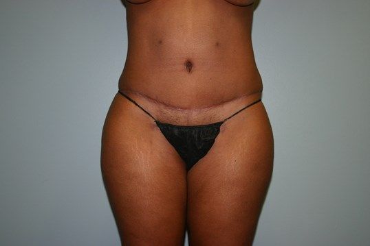 Body Contouring Before & After