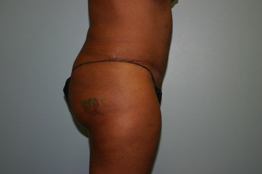 Body Contouring Before & After