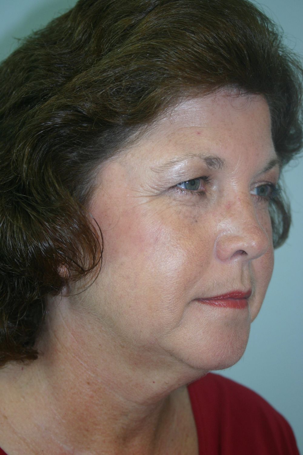 Juvederm Before & After