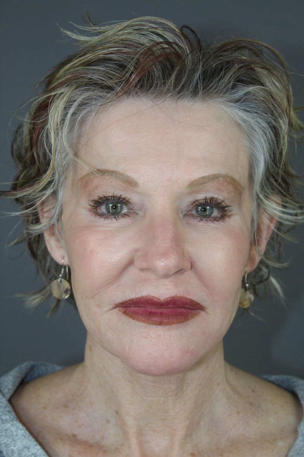 Juvederm Before & After