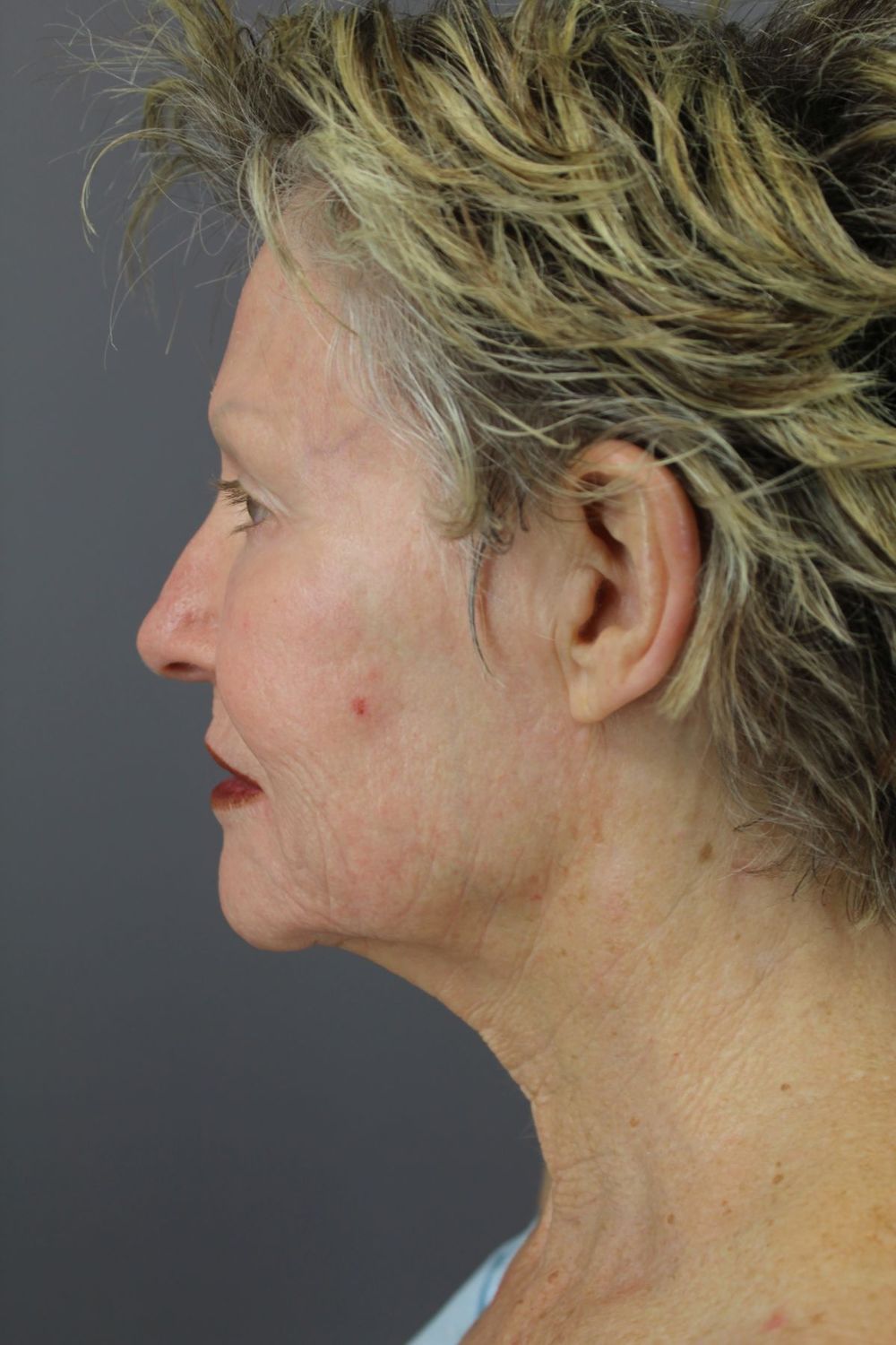 Juvederm Before & After