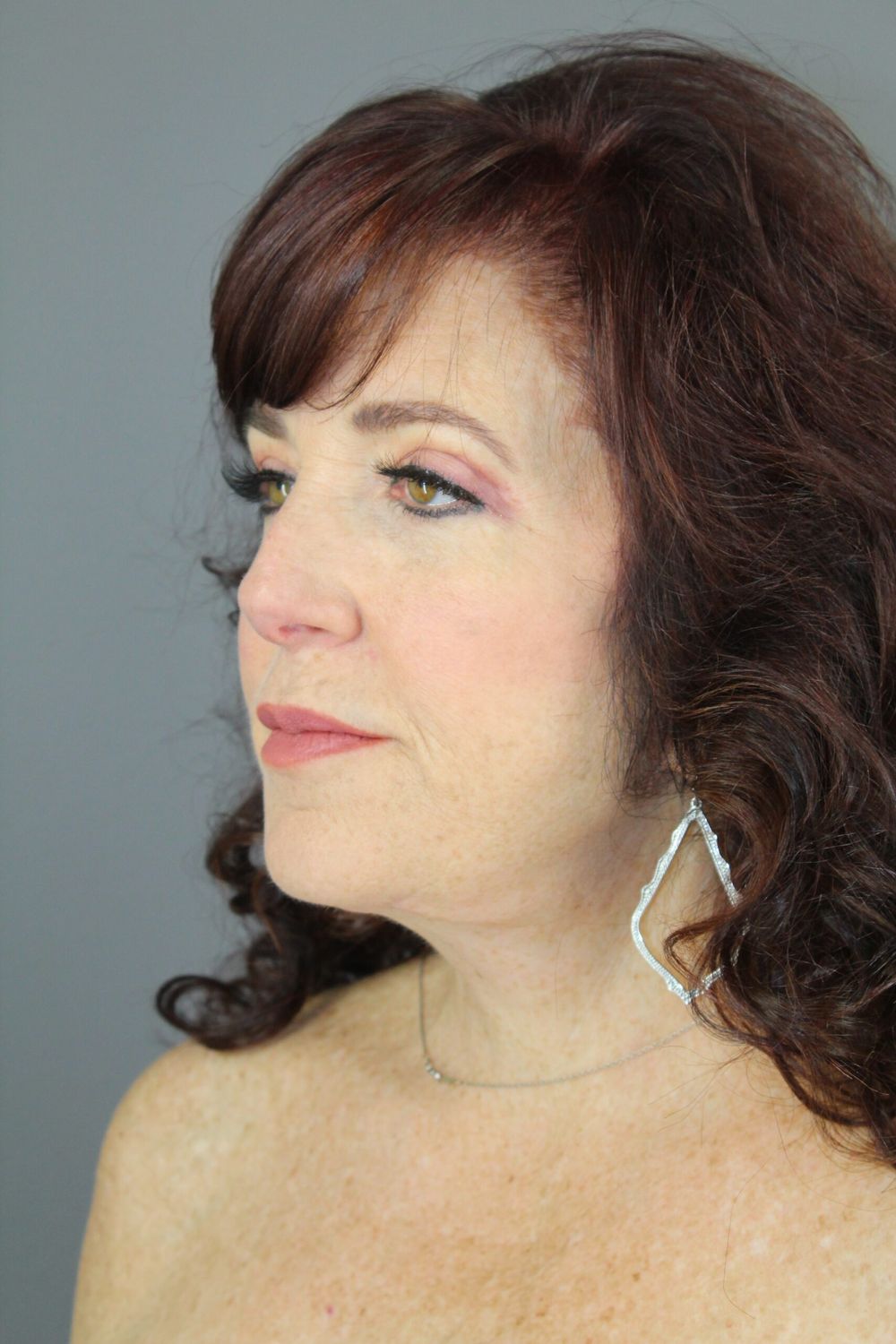 Juvederm Before & After