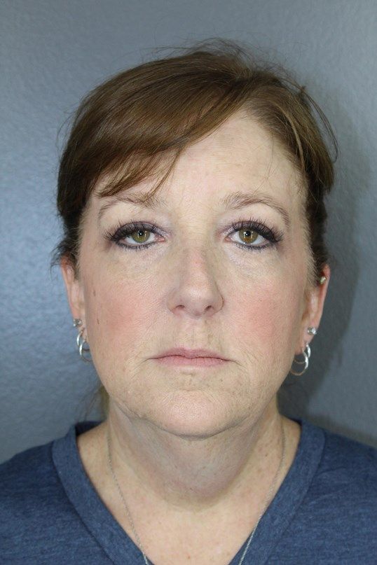 Juvederm Before & After