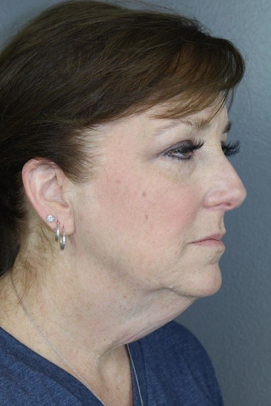 Juvederm Before & After