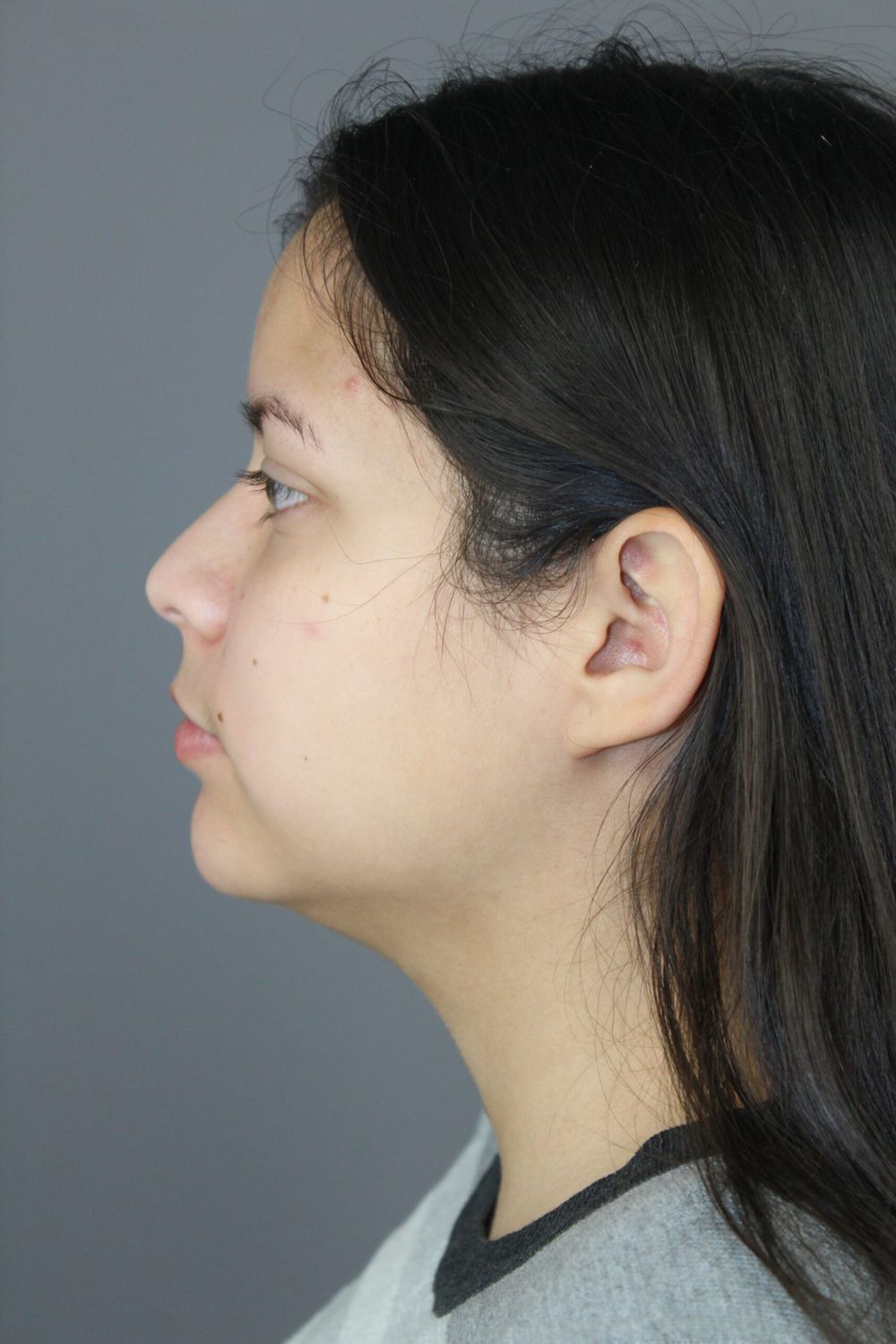 Neck Liposuction Before & After
