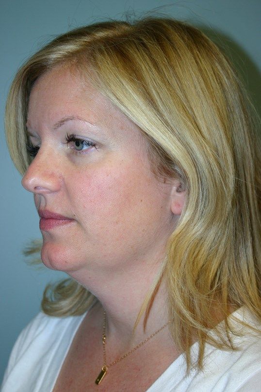 Neck Liposuction Before & After