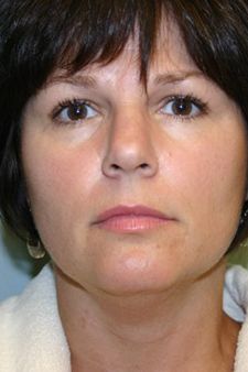 Neck Liposuction Before & After