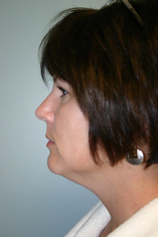 Neck Liposuction Before & After