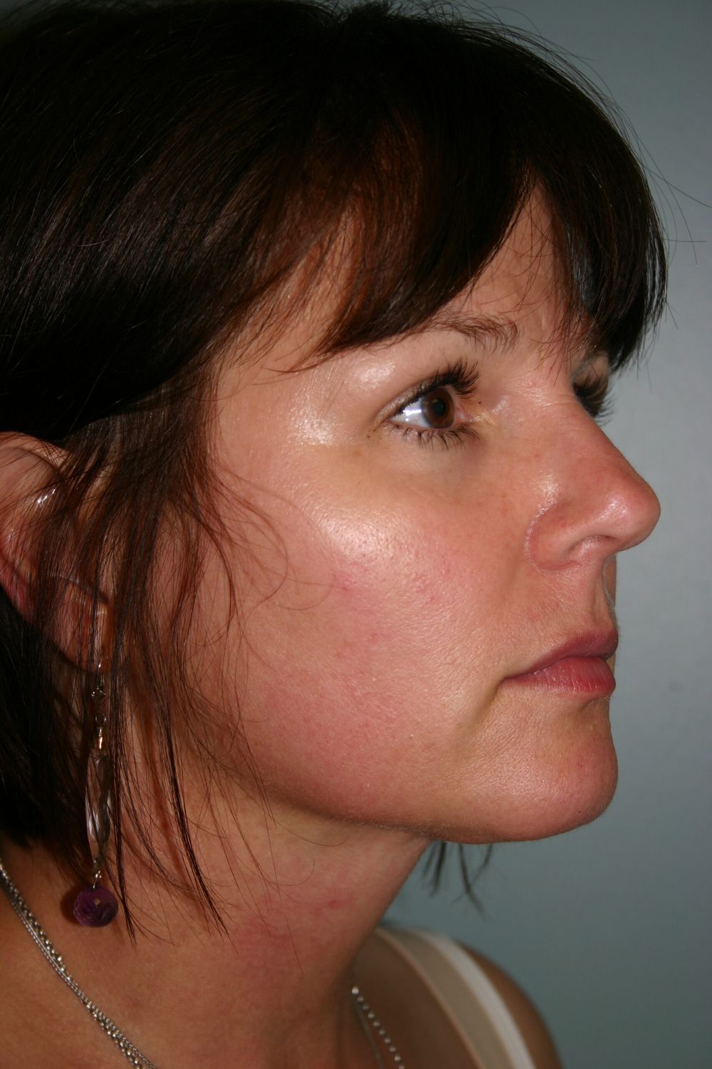 Neck Liposuction Before & After