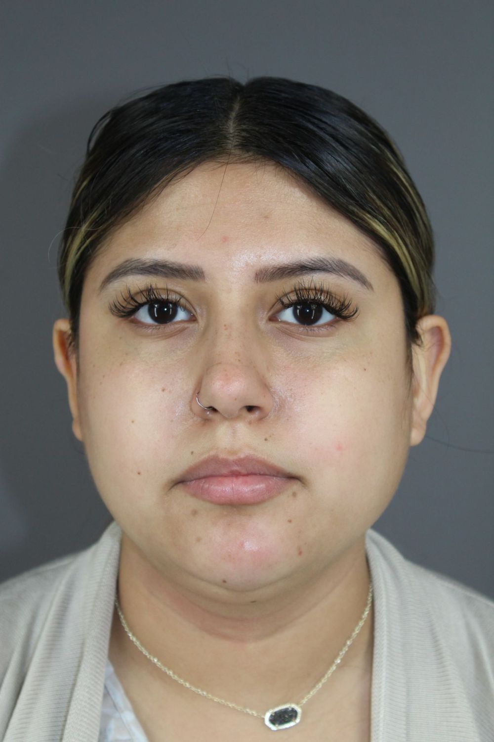 Neck Liposuction Before & After