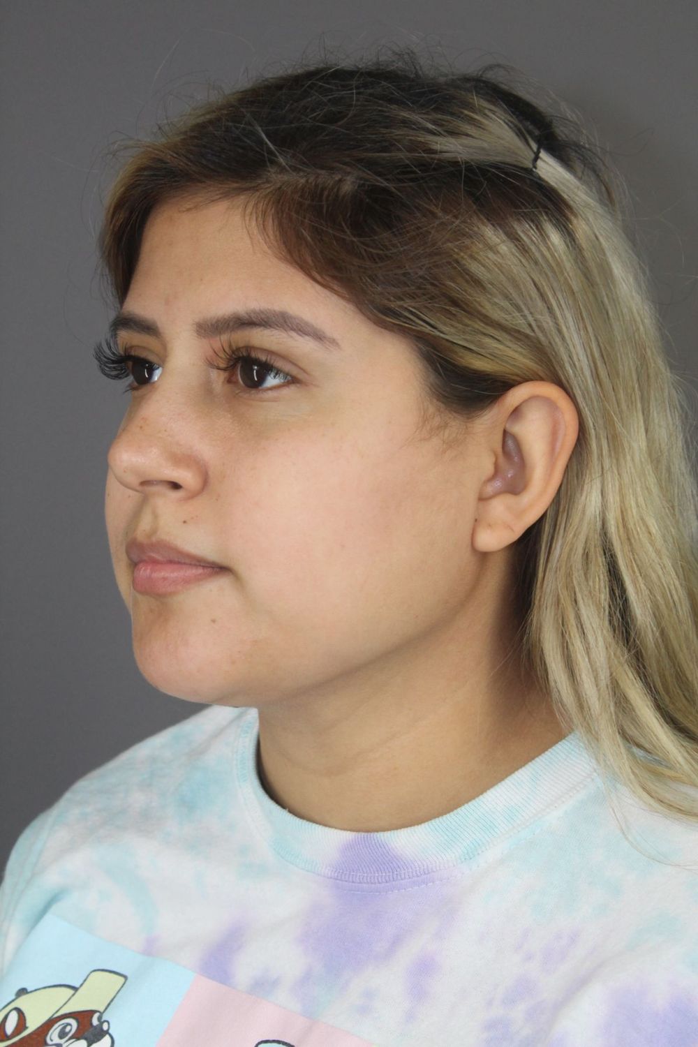 Neck Liposuction Before & After