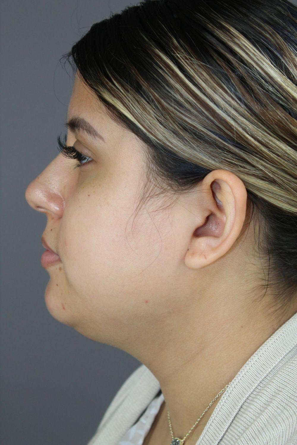 Neck Liposuction Before & After