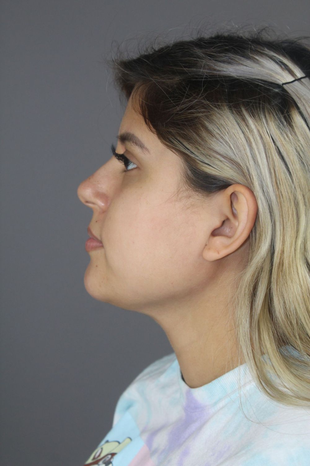 Neck Liposuction Before & After