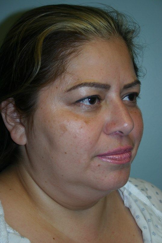 Neck Liposuction Before & After