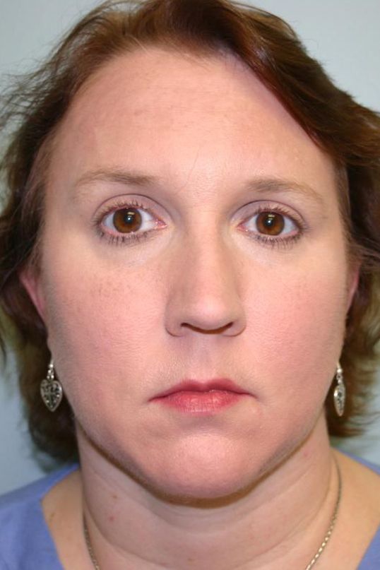 Neck Liposuction Before & After