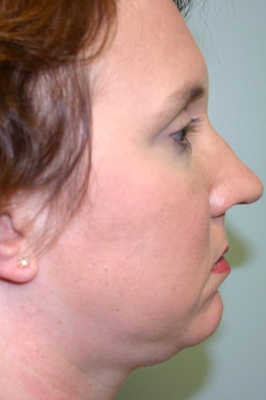 Neck Liposuction Before & After