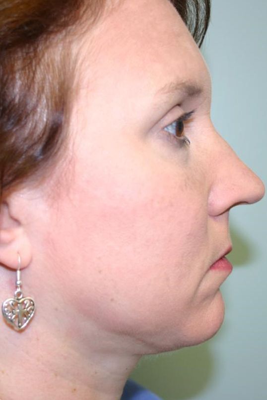 Neck Liposuction Before & After
