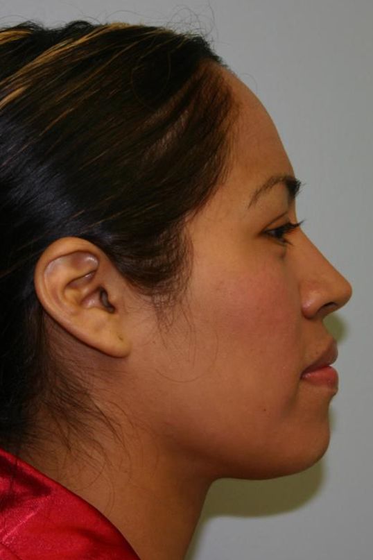 Neck Liposuction Before & After