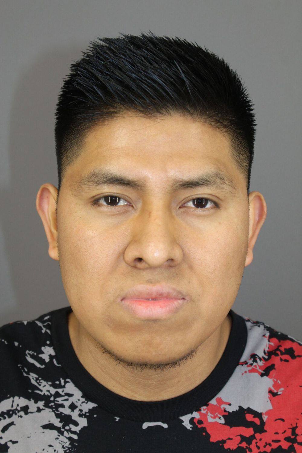 Neck Liposuction Before & After