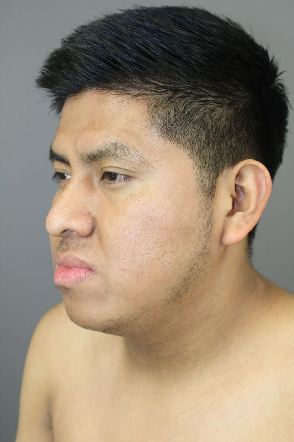 Neck Liposuction Before & After