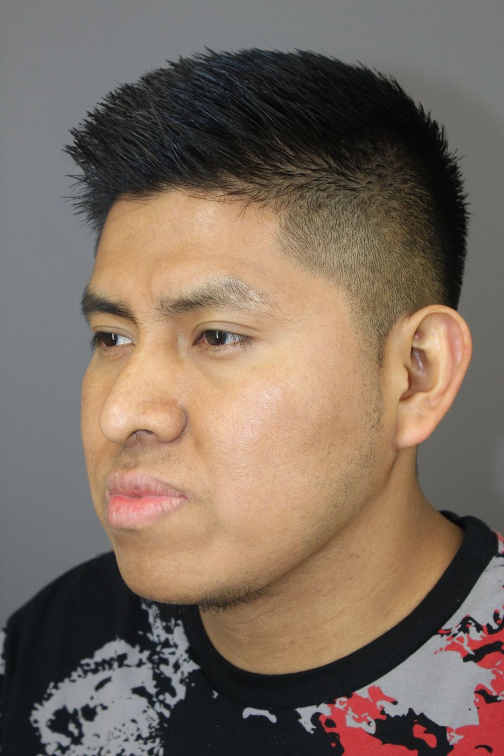 Neck Liposuction Before & After