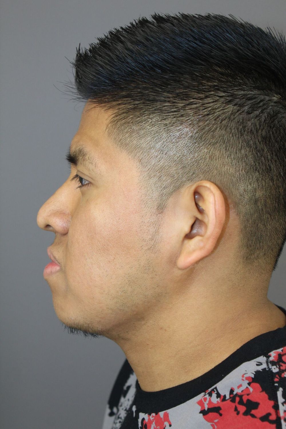 Neck Liposuction Before & After