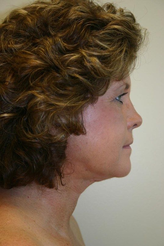 Botox Before & After