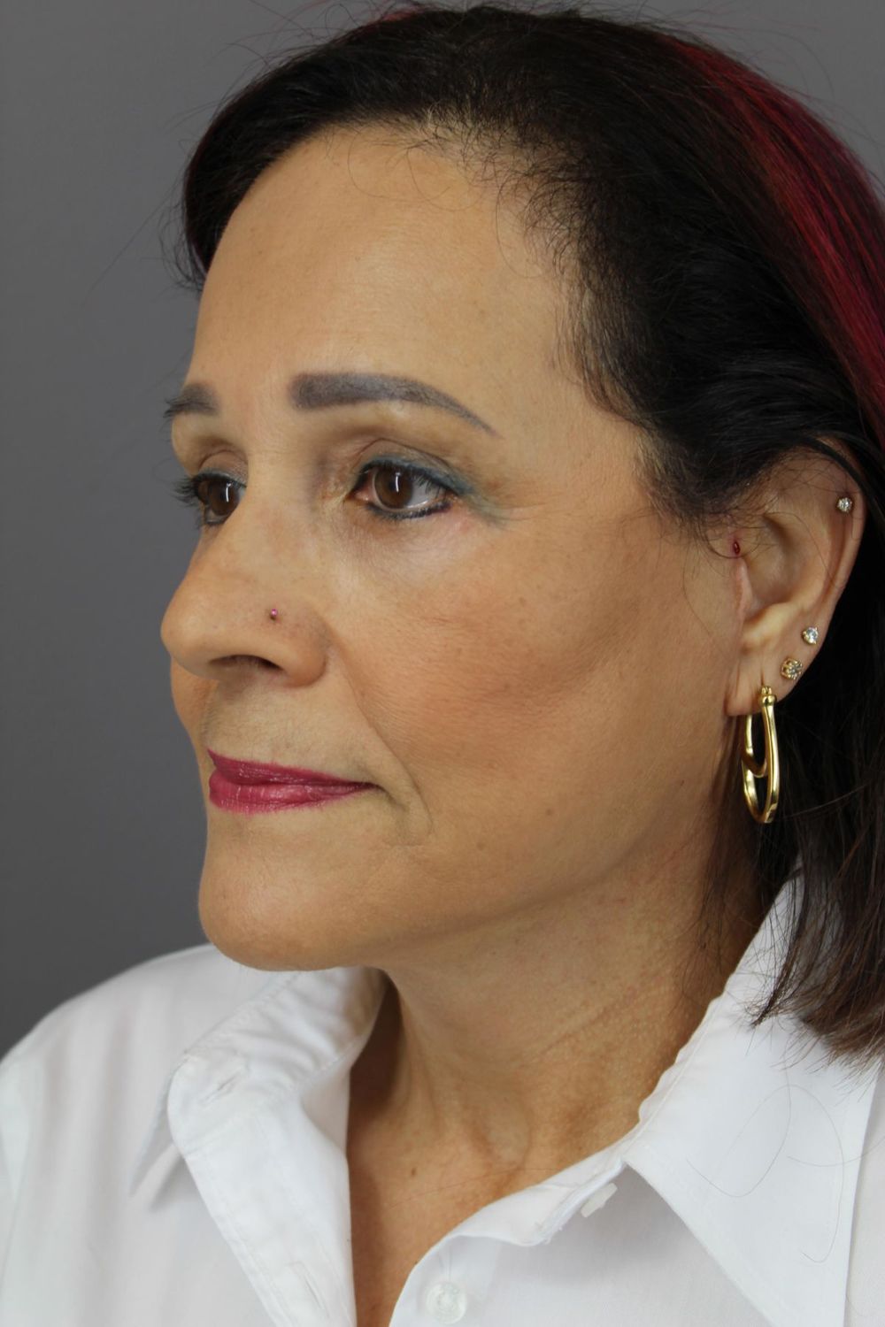 Botox Before & After