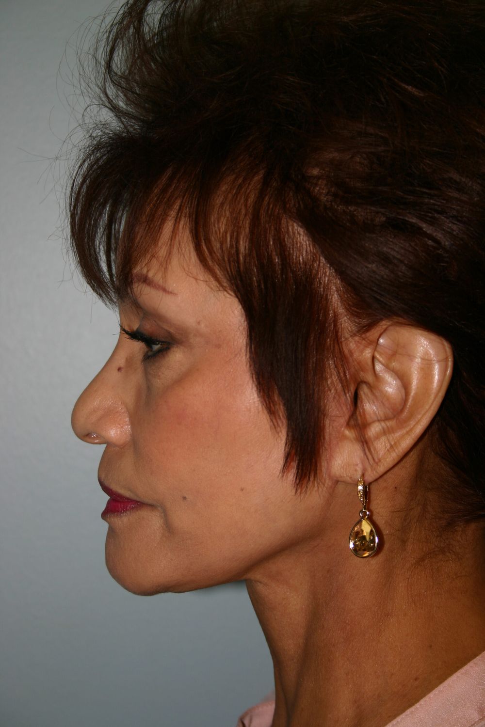 Botox Before & After