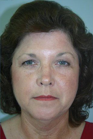 Injectable Fillers Before & After