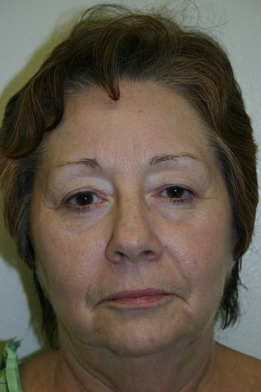 Injectable Fillers Before & After