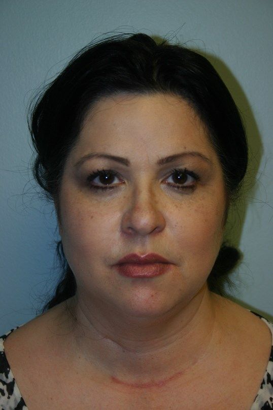 Kybella Before & After