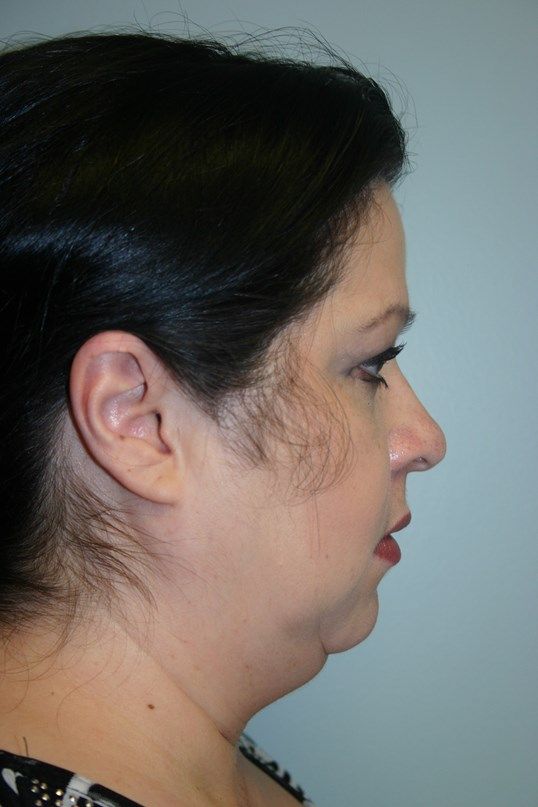 Kybella Before & After