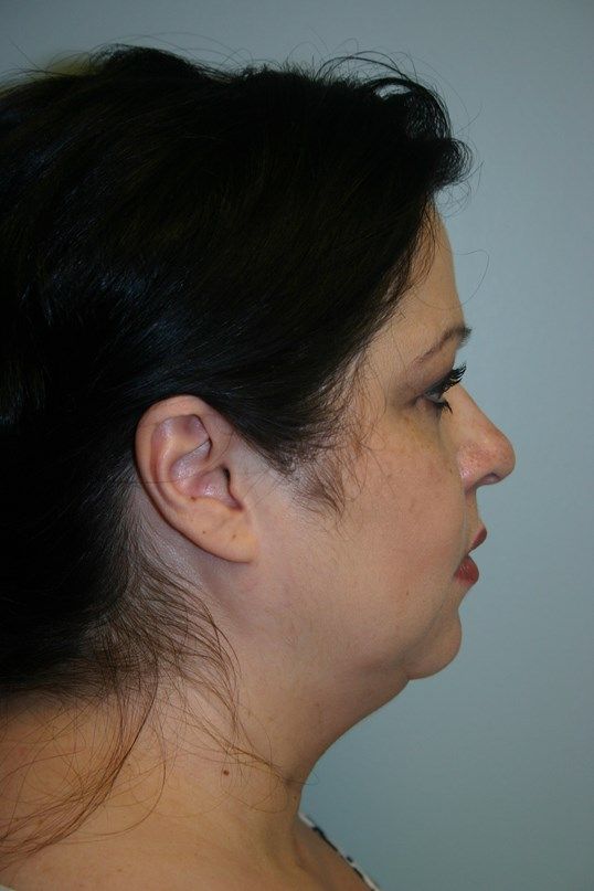 Kybella Before & After