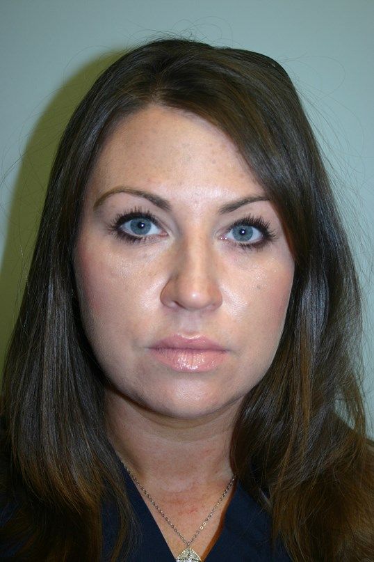 Kybella Before & After