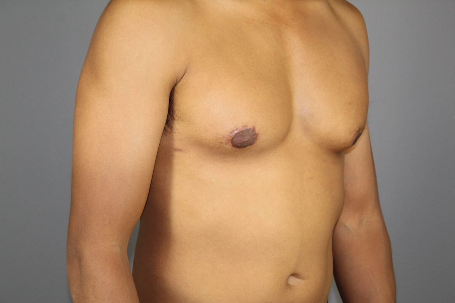 Gynecomastia Before & After