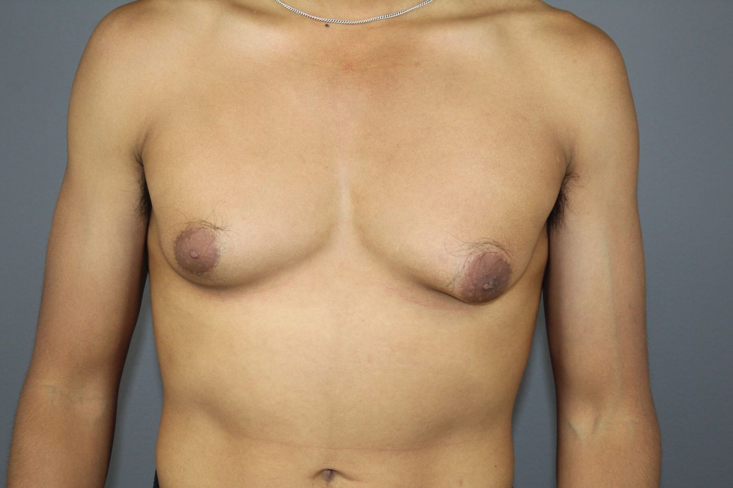Gynecomastia Before & After