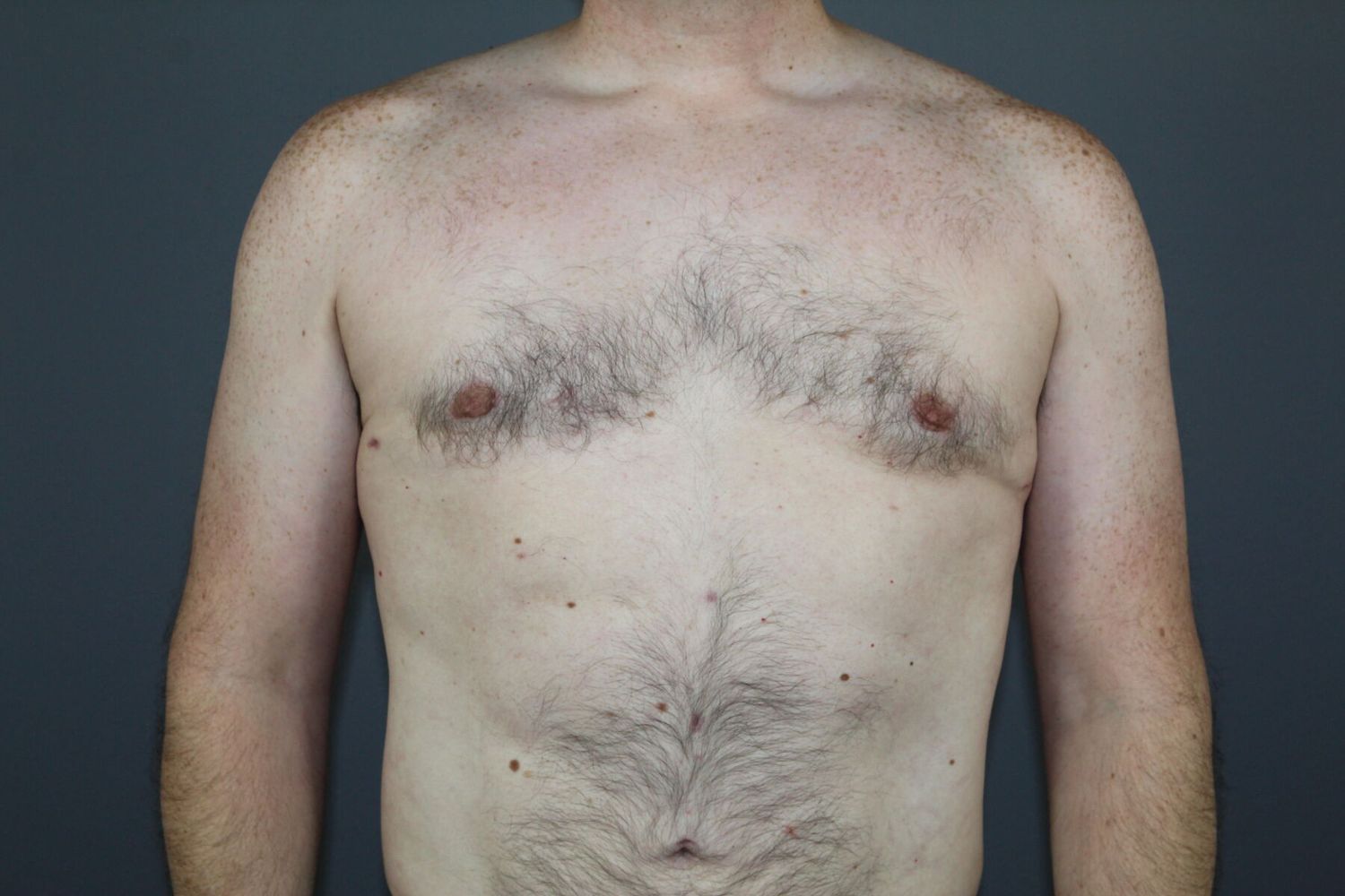 Gynecomastia Before & After