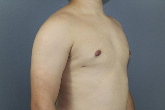 Gynecomastia Before & After