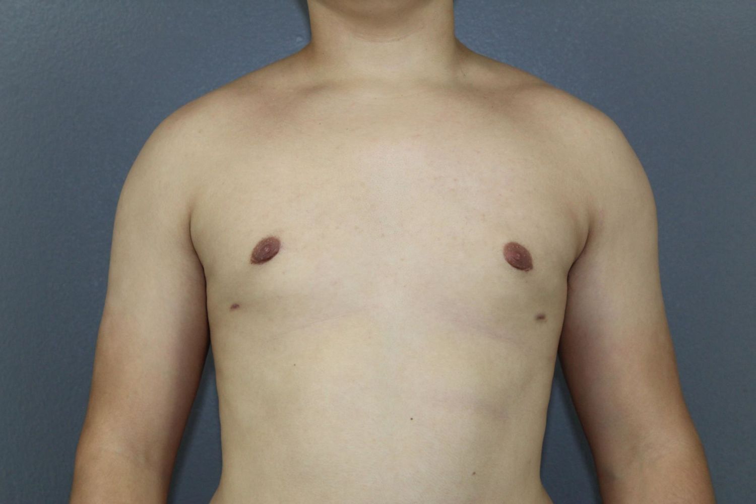 Gynecomastia Before & After