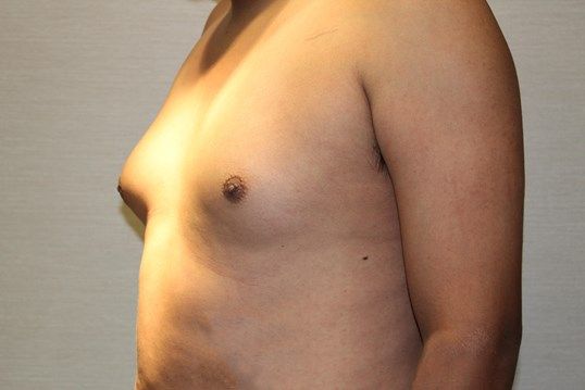 Gynecomastia Before & After